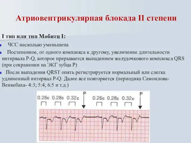 Атриовентрикулярная блокада II степени I тип или тип Мобитц I: ЧСС несколько