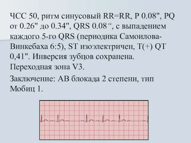 ЧСС 50, ритм синусовый RR=RR, Р 0.08", PQ от 0.26" до 0.34",