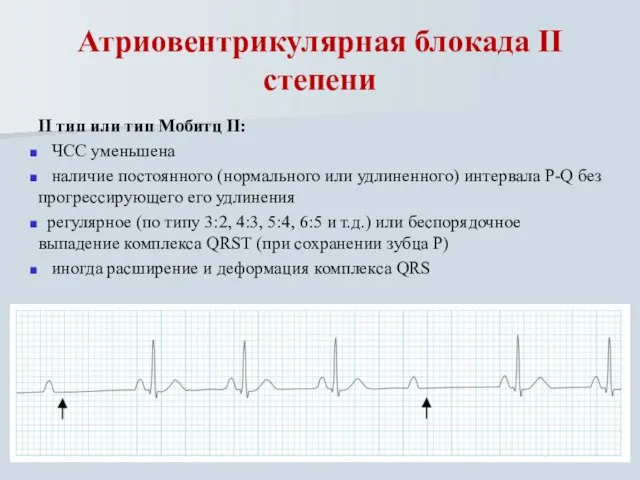 Атриовентрикулярная блокада II степени II тип или тип Мобитц II: ЧСС уменьшена