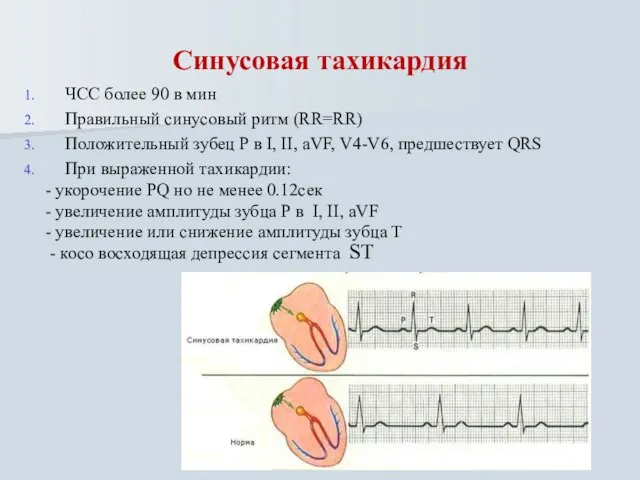 Синусовая тахикардия ЧСС более 90 в мин Правильный синусовый ритм (RR=RR) Положительный