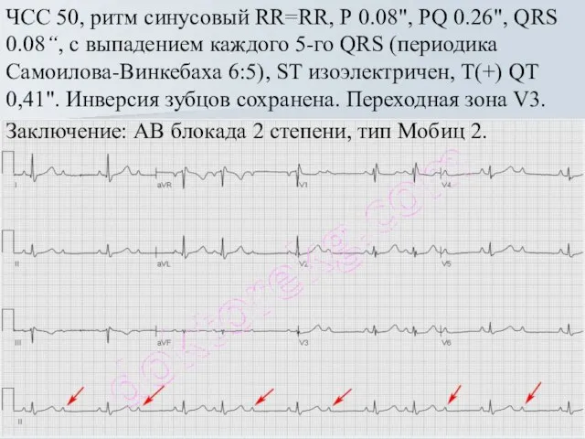 ЧСС 50, ритм синусовый RR=RR, Р 0.08", PQ 0.26", QRS 0.08“, с