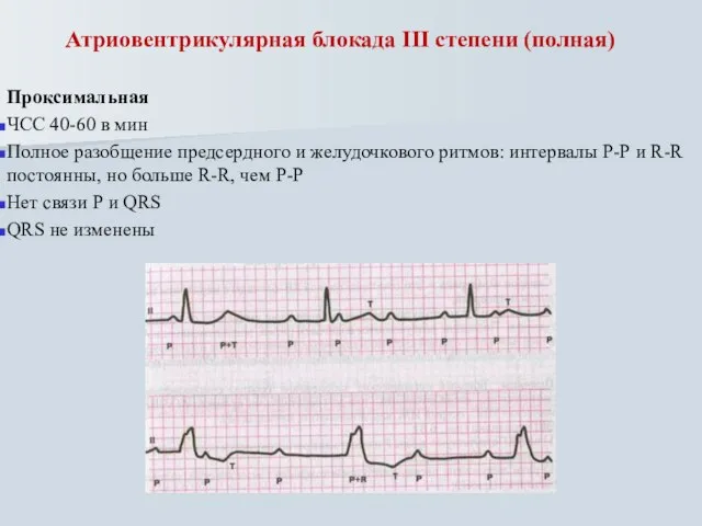 Атриовентрикулярная блокада III степени (полная) Проксимальная ЧСС 40-60 в мин Полное разобщение