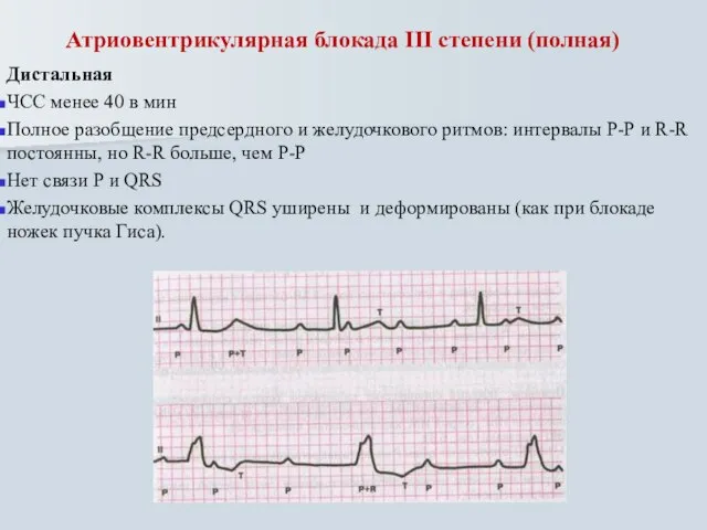 Атриовентрикулярная блокада III степени (полная) Дистальная ЧСС менее 40 в мин Полное