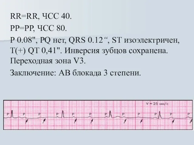 RR=RR, ЧСС 40. РР=РР, ЧСС 80. Р 0.08", PQ нет, QRS 0.12“,