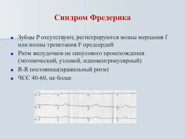 Синдром Фредерика Зубцы Р отсутствуют, регистрируются волны мерцания f или волны трепетания