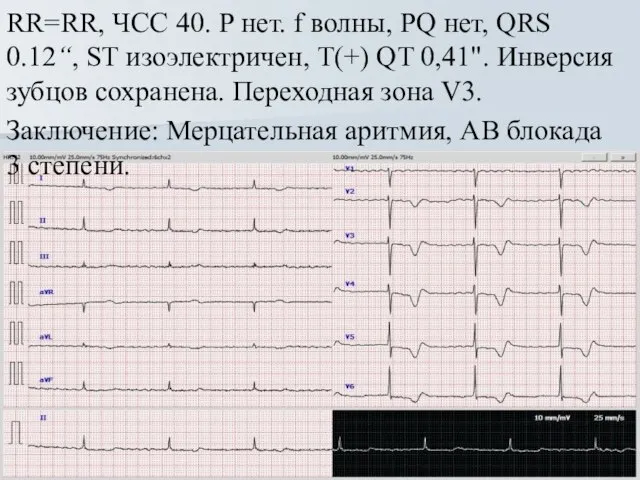 RR=RR, ЧСС 40. Р нет. f волны, PQ нет, QRS 0.12“, ST