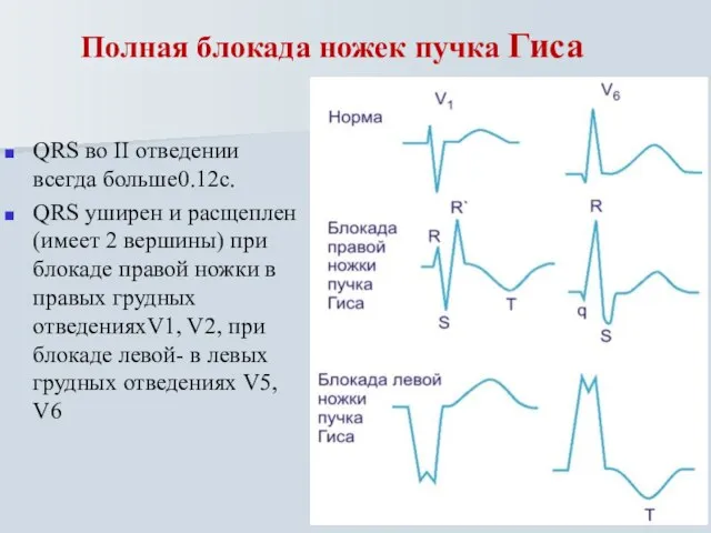 Полная блокада ножек пучка Гиса QRS во II отведении всегда больше0.12с. QRS