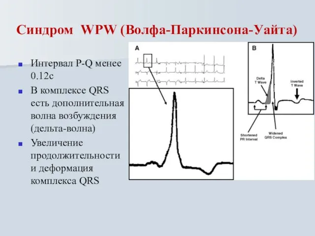 Синдром WPW (Волфа-Паркинсона-Уайта) Интервал P-Q менее 0.12с В комплексе QRS есть дополнительная
