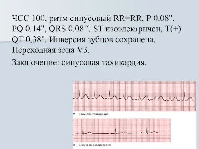 ЧСС 100, ритм синусовый RR=RR, Р 0.08", PQ 0.14", QRS 0.08“, ST