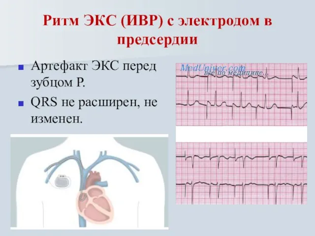 Ритм ЭКС (ИВР) с электродом в предсердии Артефакт ЭКС перед зубцом Р.