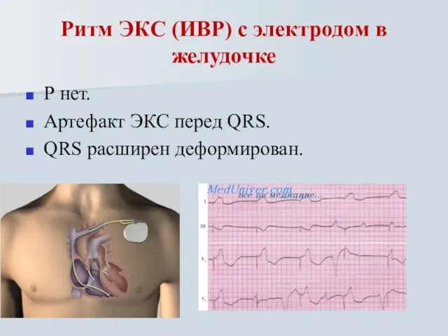 Ритм ЭКС (ИВР) с электродом в желудочке Р нет. Артефакт ЭКС перед QRS. QRS расширен деформирован.
