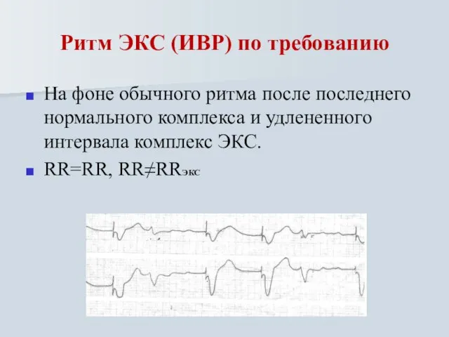 Ритм ЭКС (ИВР) по требованию На фоне обычного ритма после последнего нормального