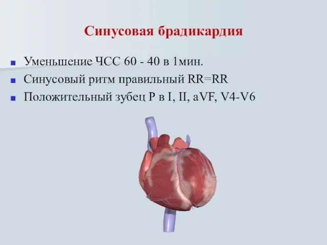 Синусовая брадикардия Уменьшение ЧСС 60 - 40 в 1мин. Синусовый ритм правильный