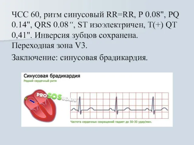 ЧСС 60, ритм синусовый RR=RR, Р 0.08", PQ 0.14", QRS 0.08“, ST