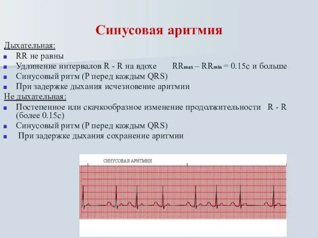 Синусовая аритмия Дыхательная: RR не равны Удлинение интервалов R - R на