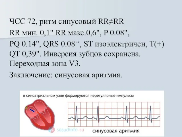 ЧСС 72, ритм синусовый RR≠RR RR мин. 0,1" RR макс.0,6", Р 0.08",