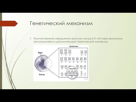 Генетический механизм Количественное нарушение аутосом, когда к 21-ой паре хромосом присоединяется дополнительный генетический материал.