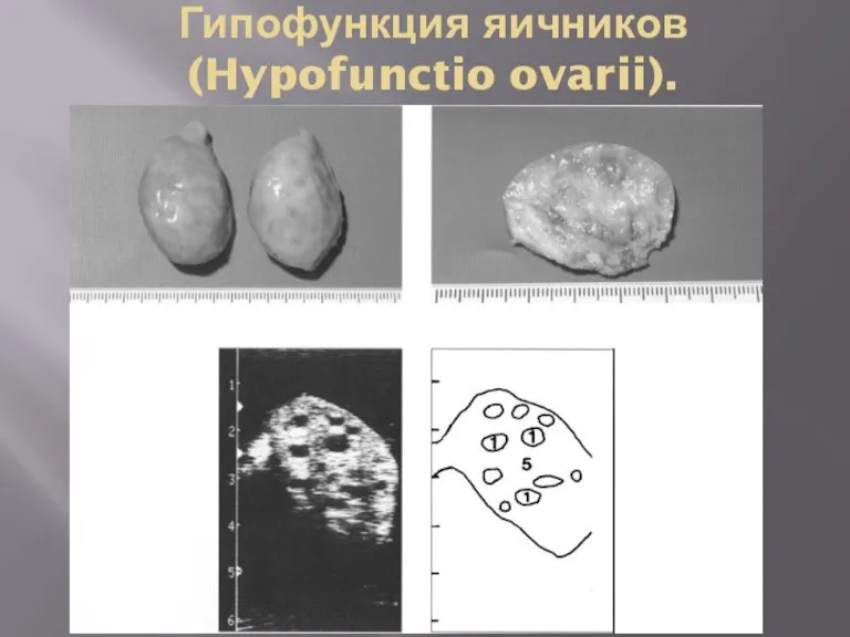 Гипофункция яичников (Hypofunctio ovarii).
