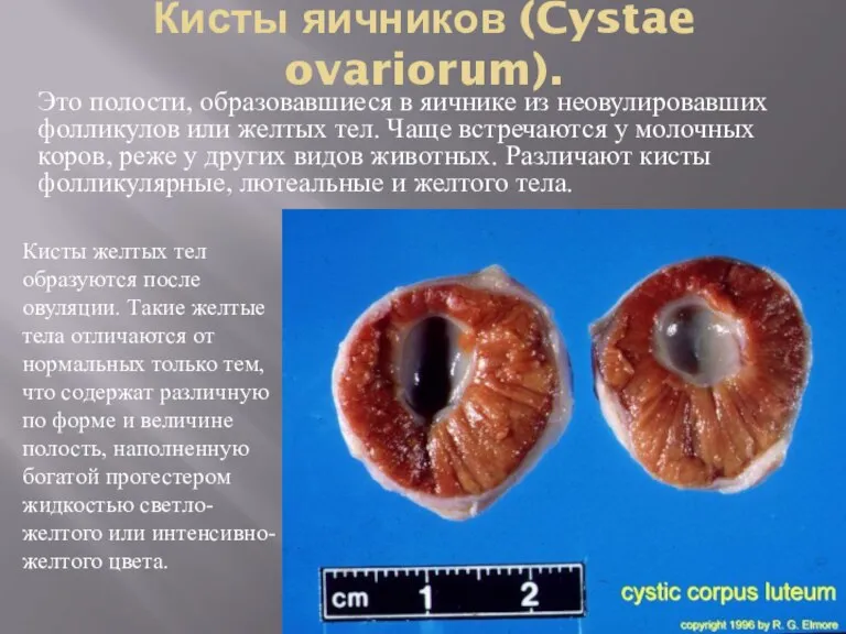 Кисты яичников (Cystae ovariorum). Это полости, образовавшиеся в яичнике из неовулировавших фолликулов