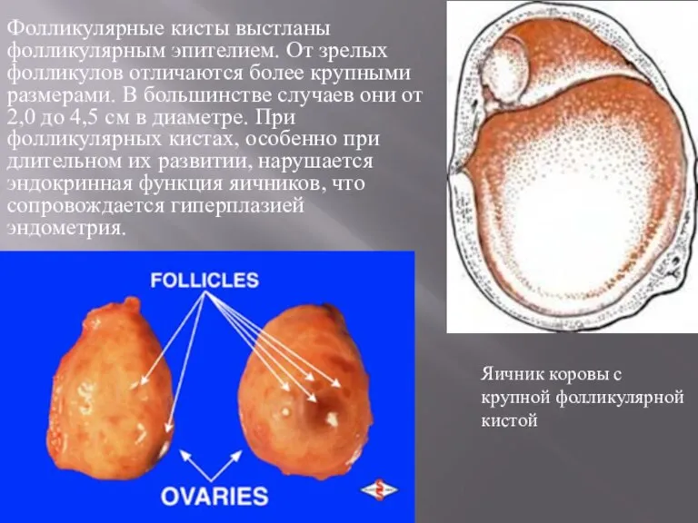 Фолликулярные кисты выстланы фолликулярным эпителием. От зрелых фолликулов отличаются более крупными размерами.