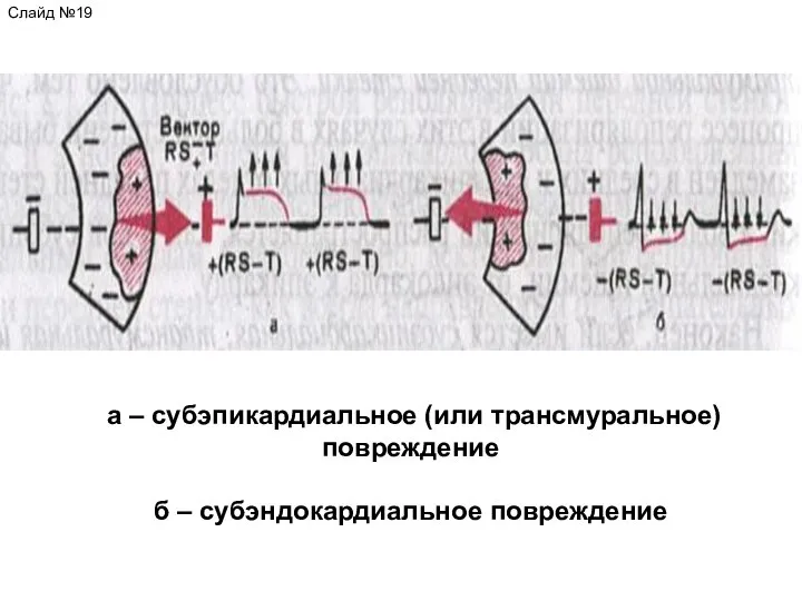 Слайд №19 а – субэпикардиальное (или трансмуральное) повреждение б – субэндокардиальное повреждение