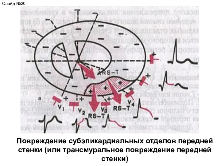 Повреждение субэпикардиальных отделов передней стенки (или трансмуральное повреждение передней стенки) Слайд №20