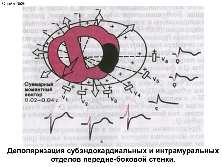 Деполяризация субэндокардиальных и интрамуральных отделов передне-боковой стенки. Слайд №26