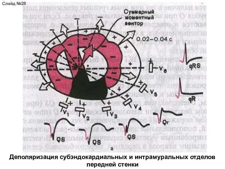 Слайд №28 Деполяризация субэндокардиальных и интрамуральных отделов передней стенки