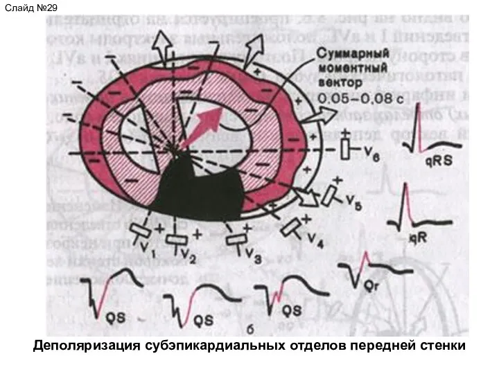 Слайд №29 Деполяризация субэпикардиальных отделов передней стенки