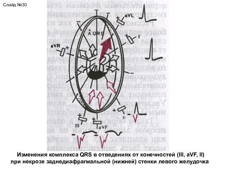 Слайд №30 Изменения комплекса QRS в отведениях от конечностей (III, aVF, II)