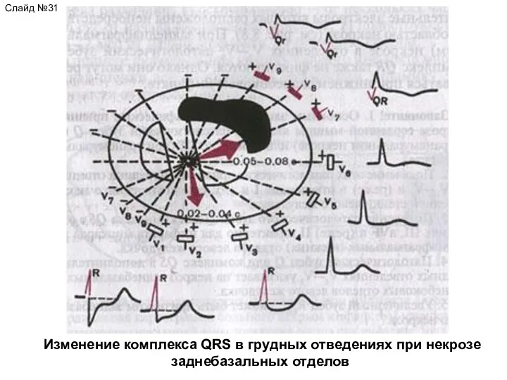 Изменение комплекса QRS в грудных отведениях при некрозе заднебазальных отделов Слайд №31