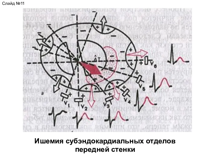 Ишемия субэндокардиальных отделов передней стенки Слайд №11