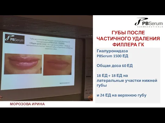 ГУБЫ ПОСЛЕ ЧАСТИЧНОГО УДАЛЕНИЯ ФИЛЛЕРА ГК ДО И ПОСЛЕ Гиалуронидаза PBSerum 1500