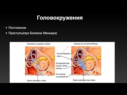 Головокружения Постоянное Приступы(при Болезни Меньера)