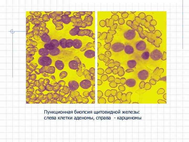 Пункционная биопсия щитовидной железы: слева клетки аденомы, справа - карциномы