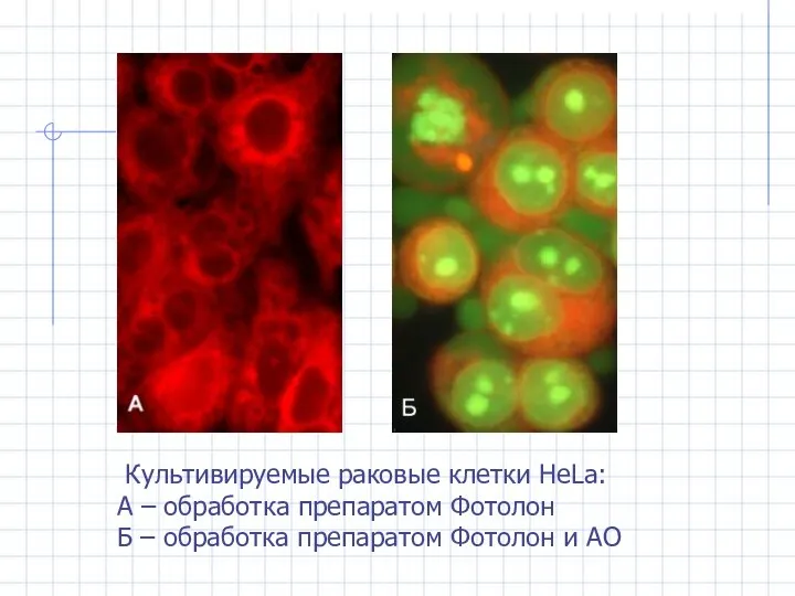 Культивируемые раковые клетки HeLa: А – обработка препаратом Фотолон Б – обработка препаратом Фотолон и АО