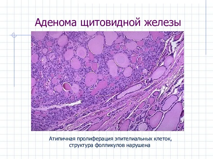 Аденома щитовидной железы Атипичная пролиферация эпителиальных клеток, структура фолликулов нарушена