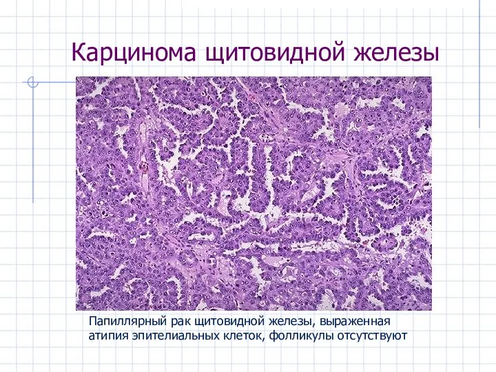 Карцинома щитовидной железы Папиллярный рак щитовидной железы, выраженная атипия эпителиальных клеток, фолликулы отсутствуют