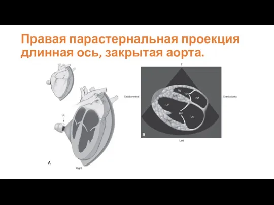 Правая парастернальная проекция длинная ось, закрытая аорта.