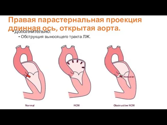 Дополнительно: Обструкция выносящего тракта ЛЖ. Правая парастернальная проекция длинная ось, открытая аорта.