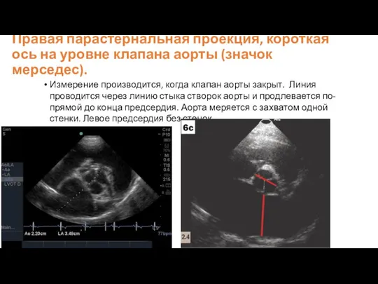 Правая парастернальная проекция, короткая ось на уровне клапана аорты (значок мерседес). Измерение