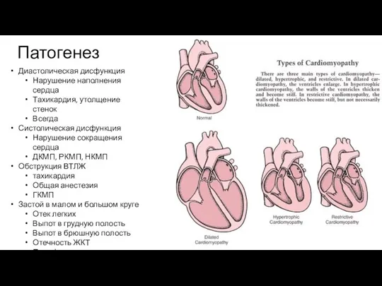 Патогенез Диастолическая дисфункция Нарушение наполнения сердца Тахикардия, утолщение стенок Всегда Систолическая дисфункция