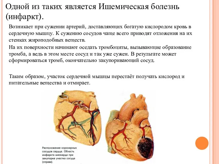 Одной из таких является Ишемическая болезнь (инфаркт). Возникает при сужении артерий, доставляющих