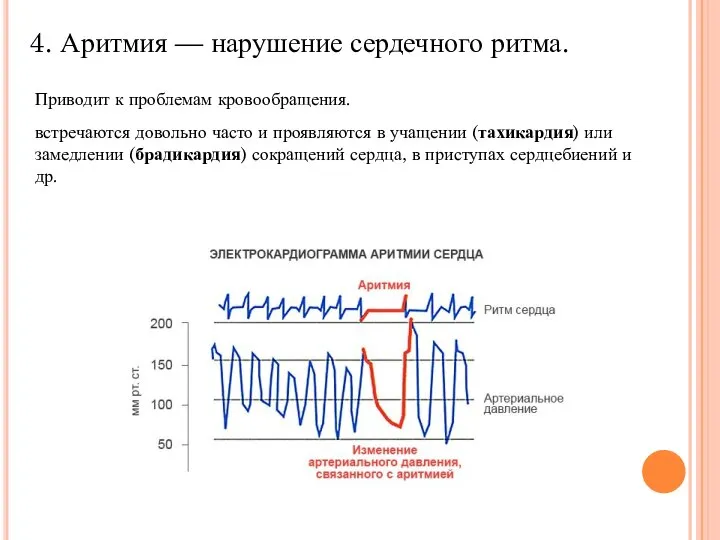 4. Аритмия — нарушение сердечного ритма. Приводит к проблемам кровообращения. встречаются довольно