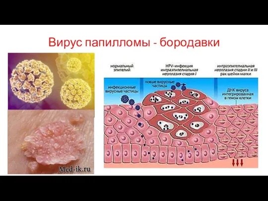 Вирус папилломы - бородавки