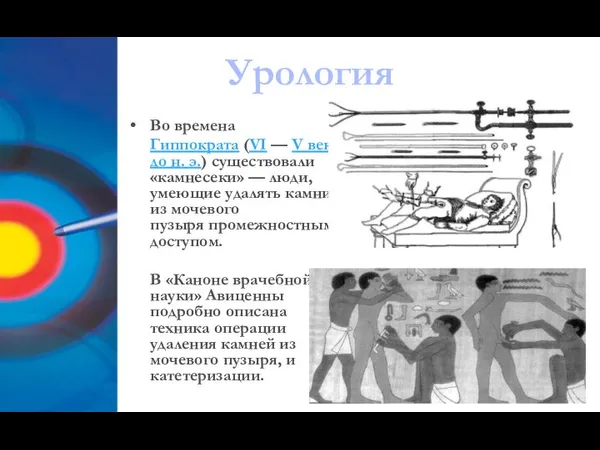 Во времена Гиппократа (VI — V век до н. э.) существовали «камнесеки»