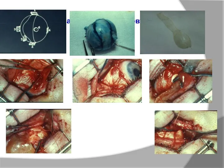 Склеропластика по Аветисову-Тарутта