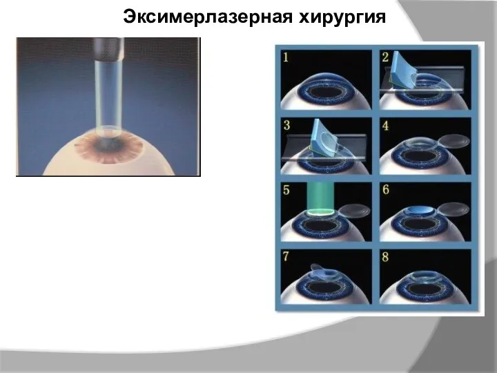 Эксимерлазерная хирургия