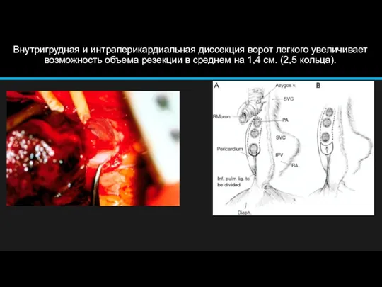 Внутригрудная и интраперикардиальная диссекция ворот легкого увеличивает возможность объема резекции в среднем
