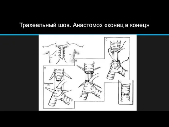 Трахеальный шов. Анастомоз «конец в конец»